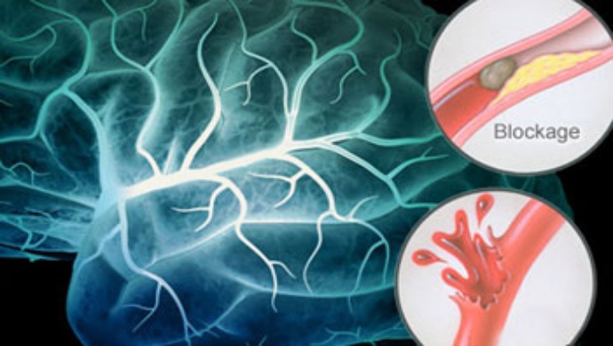 عمر الإصابة بـ "السكتة الدماغية" في إيران أقل بعشر سنوات من المتوسط العالمي