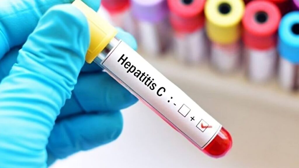 وزارة الصحة النظام الإيراني: نحو 200 ألف مصاب بفيروس التهاب الكبد "سي" في إيران